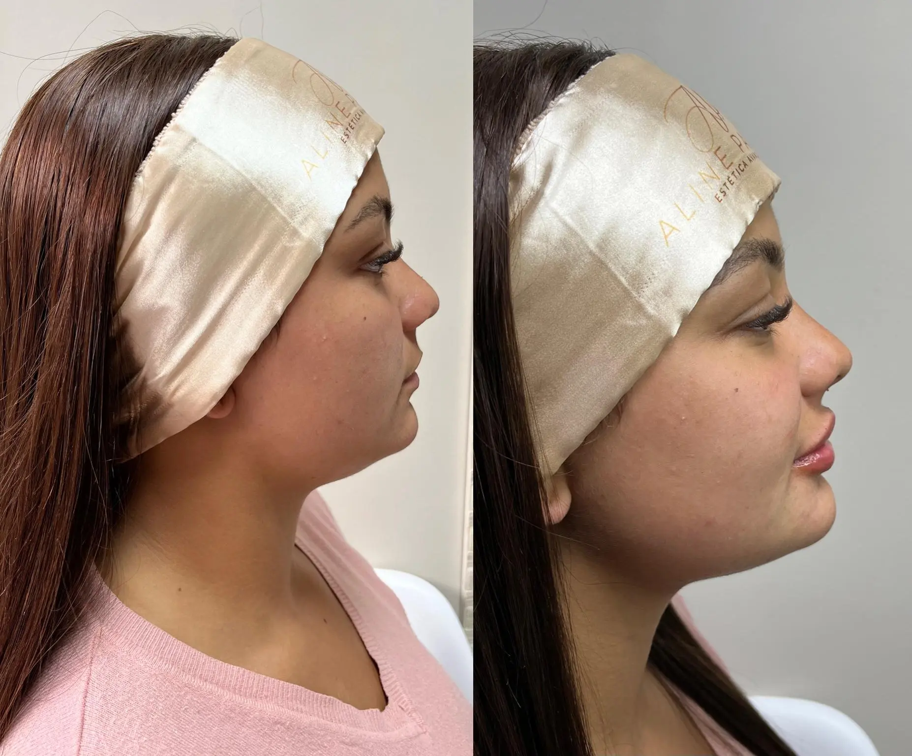 Resultado estético – antes e depois 2