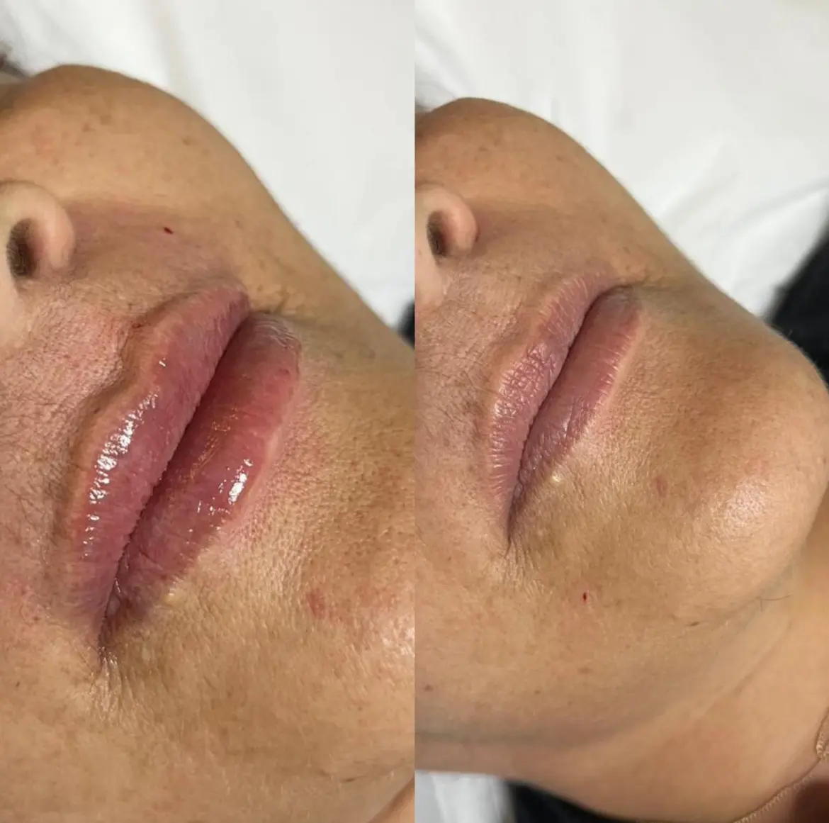 Resultado estético – antes e depois 3