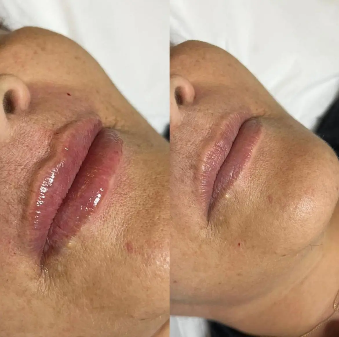 Resultado estético – antes e depois 6